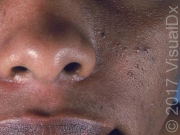 Acne-vulgaris-cheek-and-nose.jpg