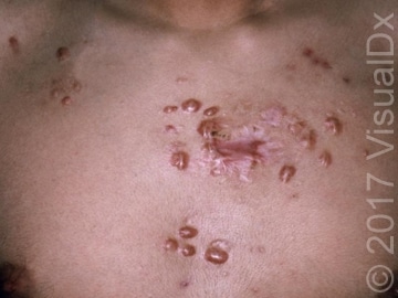Acne-vulgaris-chest.jpg