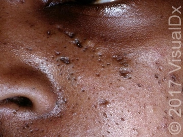 Acne-vulgaris-upper-cheek.jpg