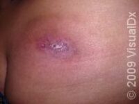 Painful Skin Bumps in Children