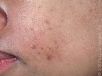 Acne and Acne-Like Conditions