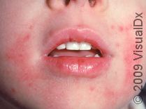 Atopic Dermatitis Eczema