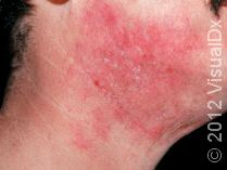 Managing Moderate-to-Severe Eczema: Update on Treatments