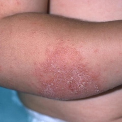 5 Common Triggers for Childhood Eczema