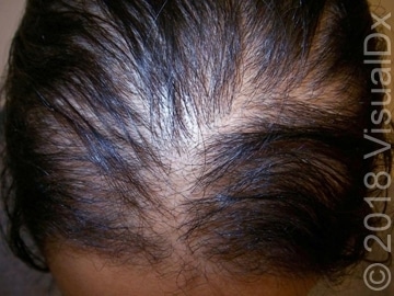Preparing for Your Dermatologist Visit: Hair Loss Basics - Skinsight