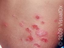 The Itchy, Crusty, or Blistered Skin of Impetigo: Advice on This Common Skin Condition.