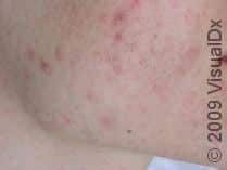 12 Days of Dermatology – Day Eight: Acne
