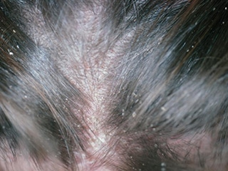 FDA Approves New Lice Treatment