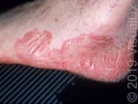 Common Complaints – Fungal Skin Infections