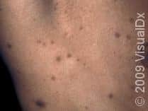 Don’t Ignore These Dark Spots on Your Skin!