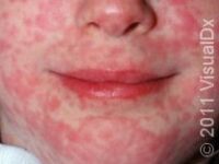 Childhood Contagious Diseases