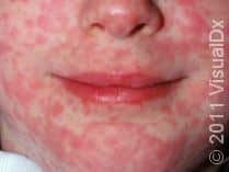 Worried about the Measles Outbreak in the U.S.?