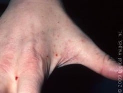 Is the scabies rash contagious?