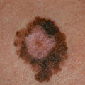 May: Skin Cancer Awareness