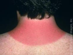 Sunburn “Pain Molecule”