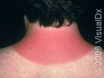 Sunburns: What a Dermatologist Wants You to Know