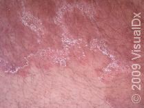 Where on the body is the most common place to get ringworm?