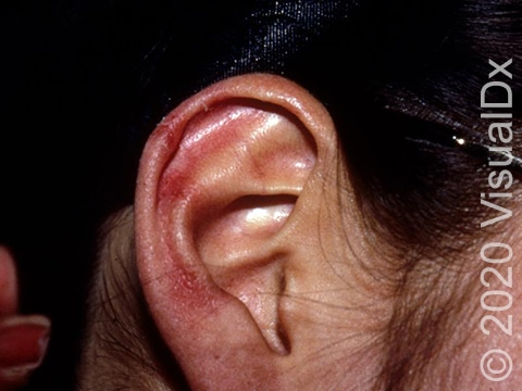 Redness and small bumps on the ear.