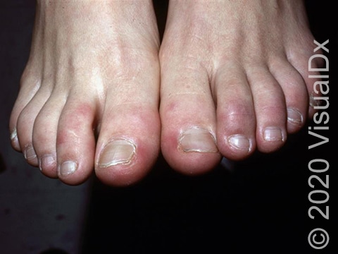 Red-purple discoloration of toes.