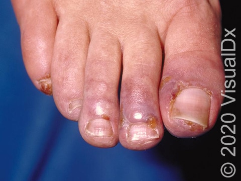 Red-purple swollen bumps with crusty scabs on the toes.