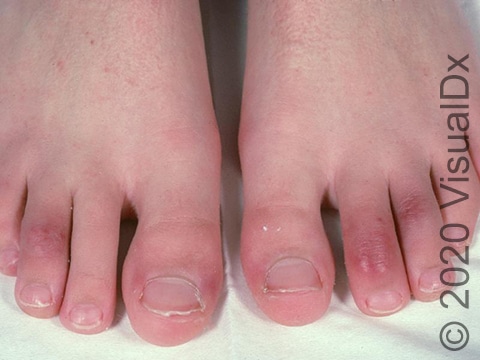 Redness and swelling of the toes.