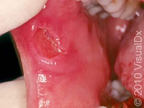 As displayed in this image, aphthous ulcers can be large, deep, and painful.