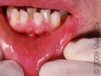 Canker Sore (Aphthous Ulcer) – Adult