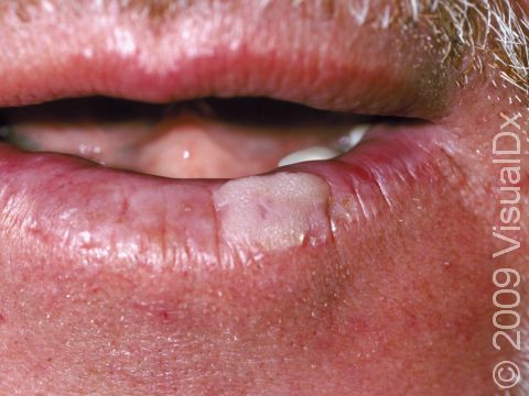 This is a wart on a patient's lower lip.