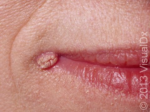 This is a wart at the edge of the lips.