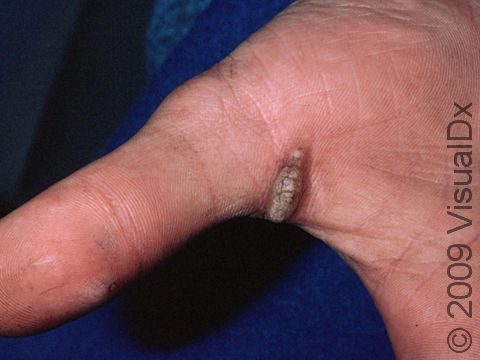 The wart seen in the webspace of the thumb has the rough and thickened appearance typical of common warts.