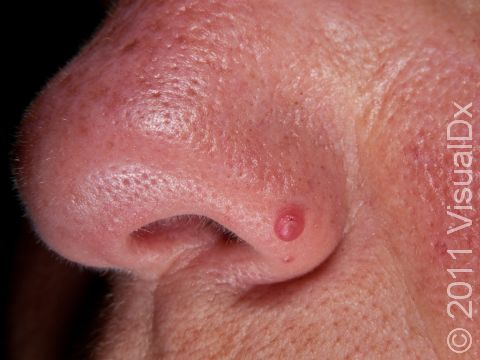A fibrous papule on the nose.
