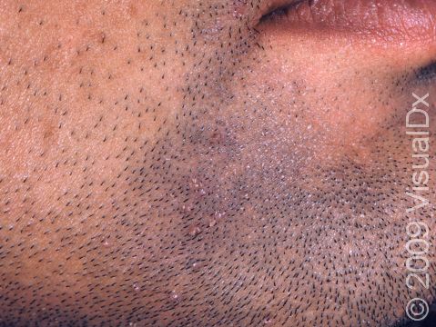 This image displays flat warts in a beard area, which are typically spread by shaving.