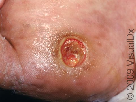 This neurogenic ulcer has occurred on a common pressure area, the ball of the foot near the great toe.