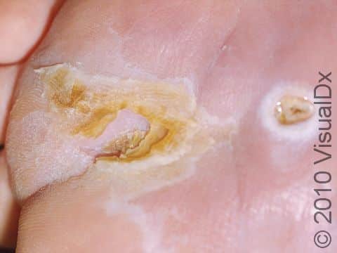 A neurogenic ulcer begins with thickening and a callus on an area of pressure, as seen on the left on this foot, followed by skin breakdown (an ulcer), as seen on the right.