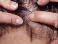 Head Lice (Pediculosis Capitis) – Adult