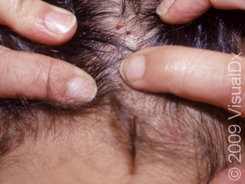 Head Lice (Pediculosis Capitis) Condition, Treatments and Pictures for  Adults - Skinsight