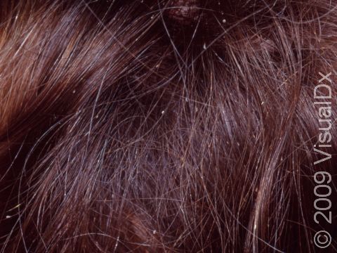 Numerous tiny, white lice eggs (nits) glued to the hair shaft are seen in this person with head lice.