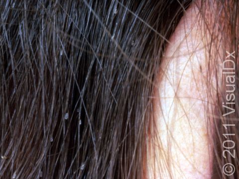 Nits are the egg cases of lice. They are seen here firmly attached to the hair.
