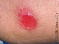 Bedsores (Pressure Ulcers) – Adult