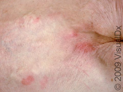 Before the skin breaks down into an ulcer, skin areas subjected to too much pressure turn red, as seen on the lower back of this elderly woman.