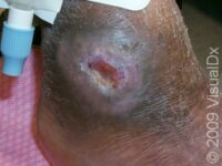 Bedsores (Pressure Ulcers)