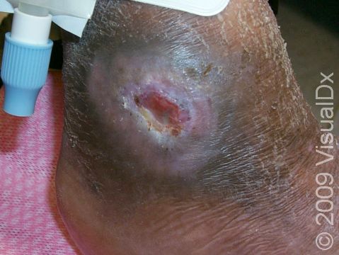 A pressure ulcer can be seen on the outer ankle area.