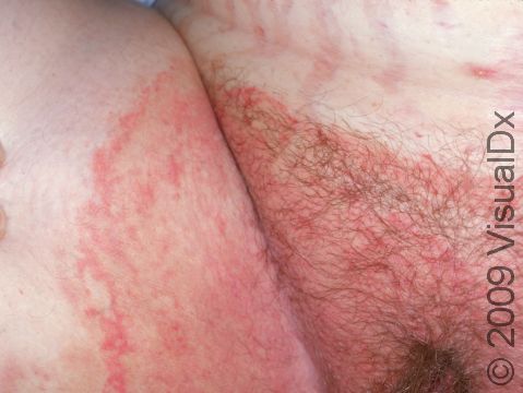 This image displays the sharp, accentuated edge of the skin affected with tinea cruris.