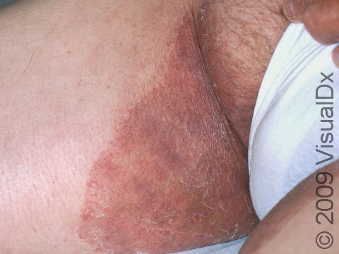 This image displays the fungal infection typical of tinea cruris (