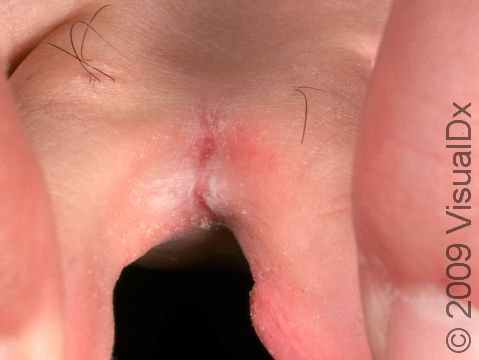 This image displays the fungal infection that frequently occurs between the toes, tinea pedis (athlete's foot).