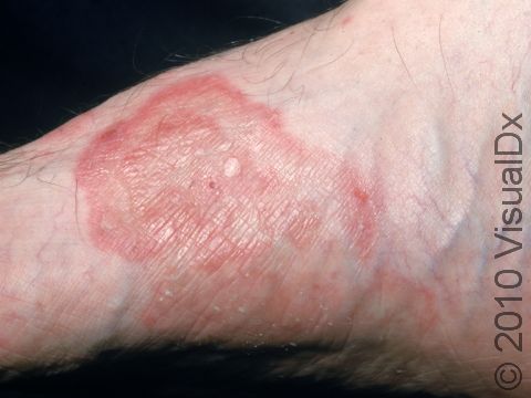 This image displays a scaly border and pink, slightly elevated lesions typical of tinea pedis (athlete's foot, foot ringworm).