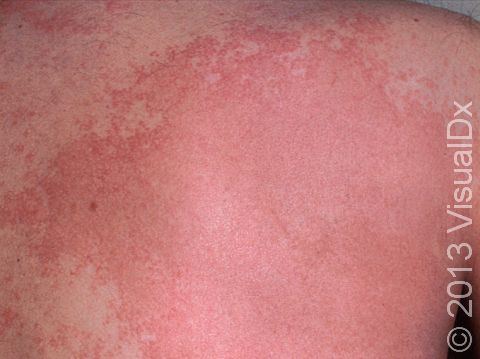 This image displays severe hives (urticaria) from taking aspirin.