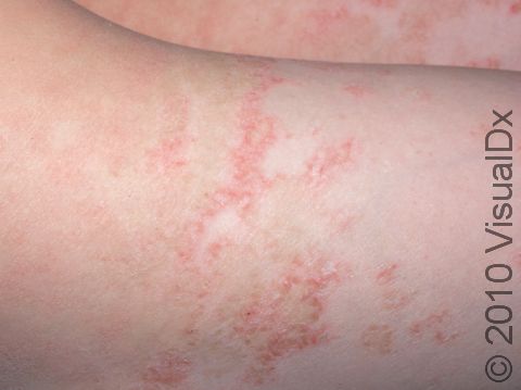 This image displays a dry, scaly rash due to itching from xerosis (dry skin).