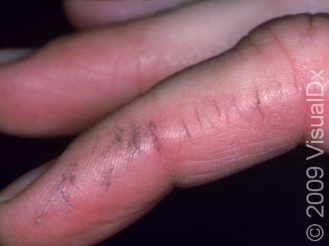This image displays cracks in the skin due to xerosis (dry skin) that have collected dirt.