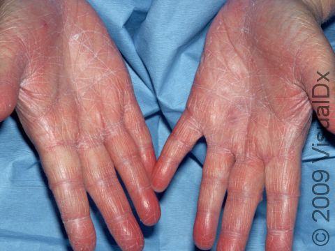 This image displays very dry skin on the hands typical of xerosis.